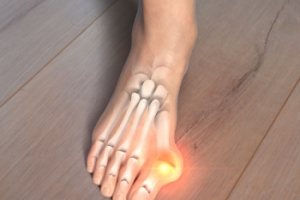 When Is Bunion Surgery Necessary?